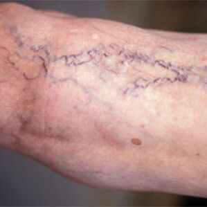 Разширени вени