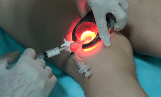 Склеротерапията е ефективен метод за лечение на разширени вени на краката